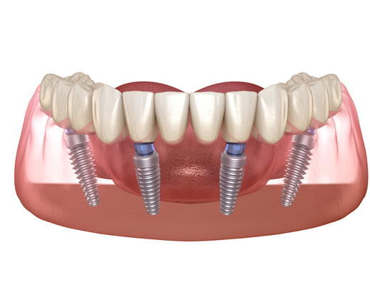 How Do All On  ® Dental Implants Work?